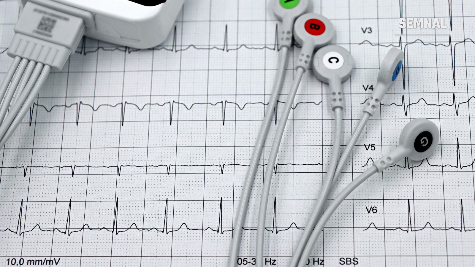Fire de electrozi ECG așezate pe o înregistrare printată de electrocardiogramă, folosită pentru diagnosticarea bolilor de inimă